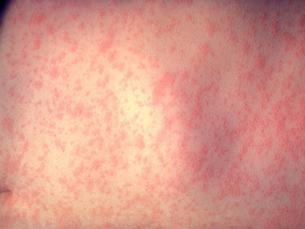 Officials end weekly Oxford, Elgin county measles updates, urge caution